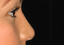 Nose Surgery