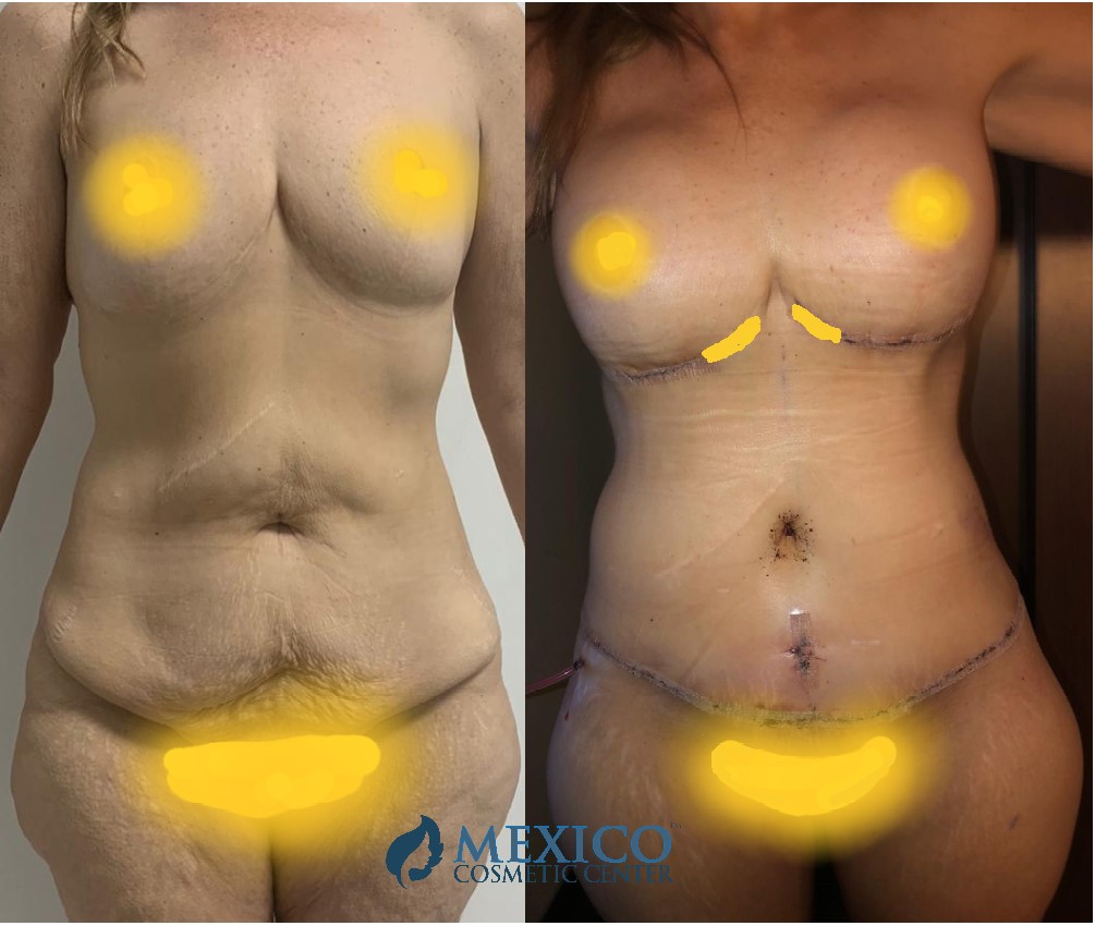 Mommy Makeover in Mexico Before and After Photos