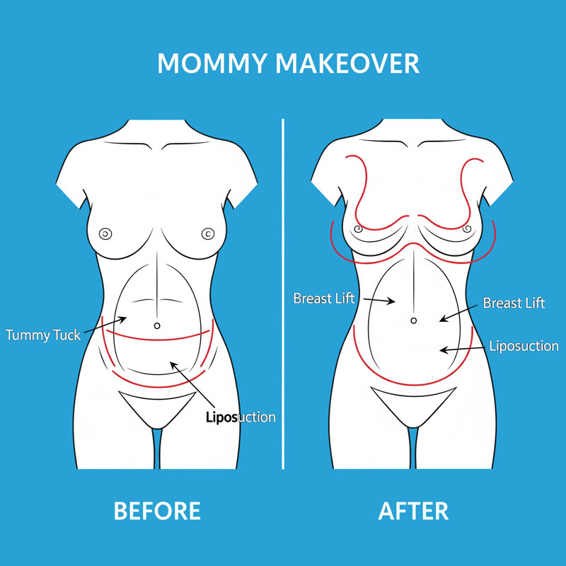 Mommy Makeover Image