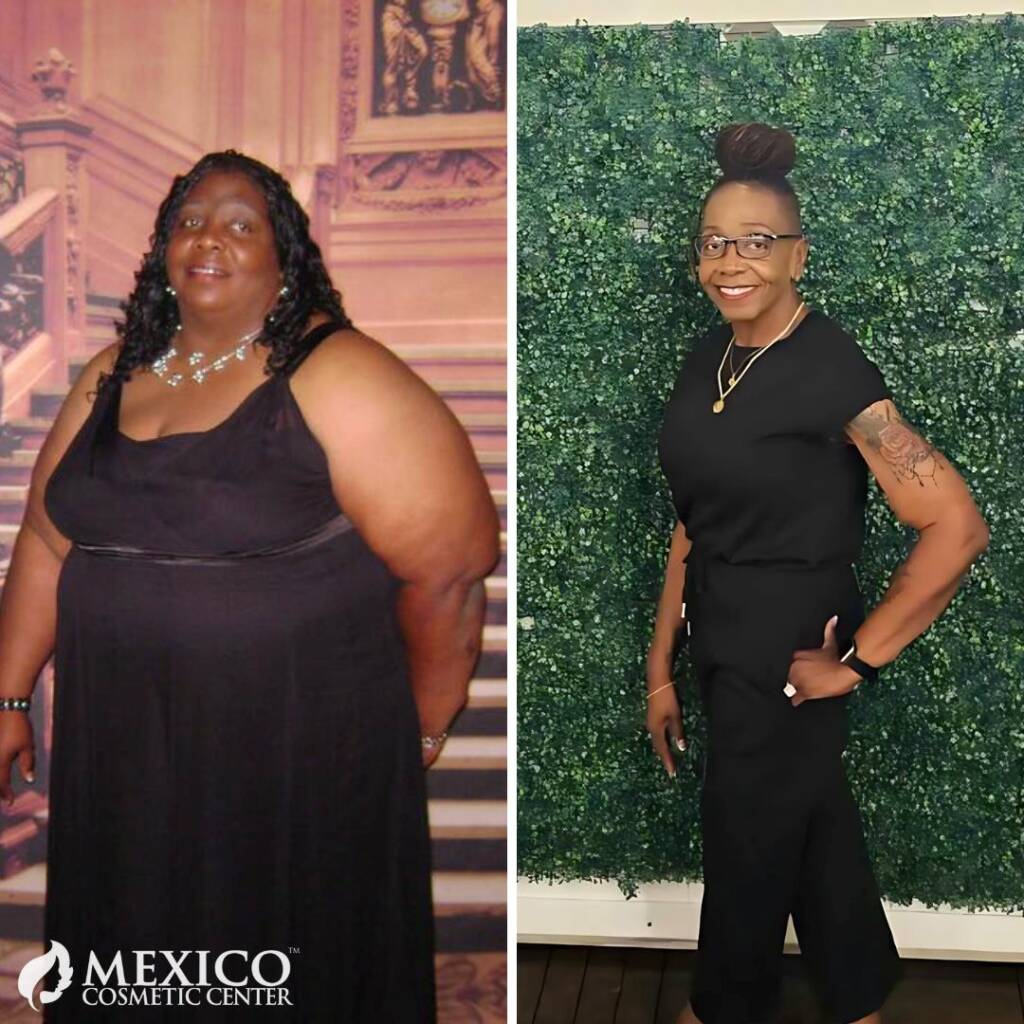 Arm Lift, Lower Body Lift, and Breast Lift